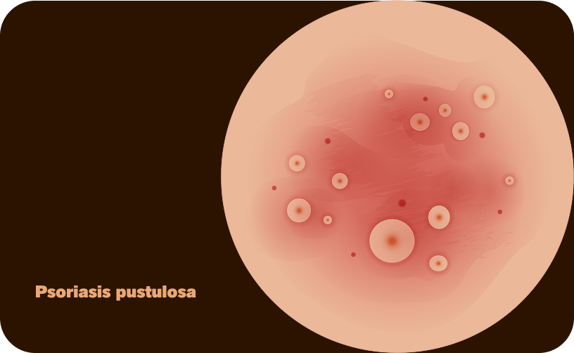 Pustulosa-DE-ohne Text